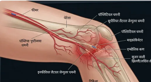 जेनिकुलर आर्टरी एम्बोलाइजेशन में घुटने की नसों तक पहुंचती पतली नली का चित्रण